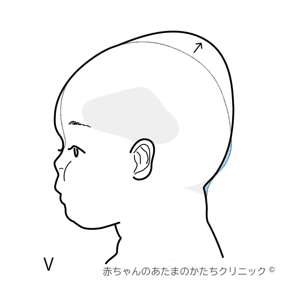 赤ちゃんの斜頭症のヘルメット治療 赤ちゃんの頭の形を矯正するヘルメット治療の赤ちゃんのあたまのかたちクリニック